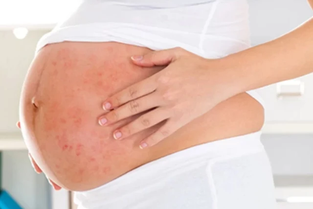 Bệnh Zona Đối Với Phụ Nữ Mang Thai: 3 Phương Pháp Điều Trị