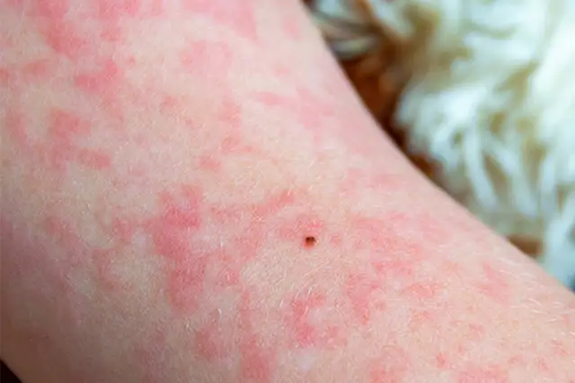 Mẹ Bầu Bị Sởi: 5 Điều Cần Biết Để Bảo Vệ Sức Khỏe Mẹ Bầu