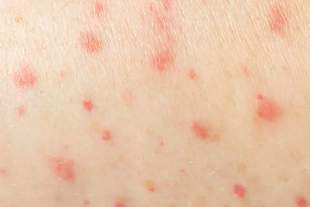 Mẹ Bầu Bị Sởi: 5 Điều Cần Biết Để Bảo Vệ Sức Khỏe Mẹ Bầu