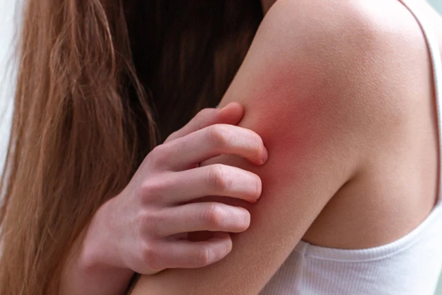 Bà Bầu Bị Ngứa: 12 Mẹo Trị Ngứa Và Nguyên Nhân Gây Nên