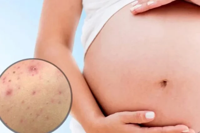 Mẹ Bầu Bị Mụn Lưng: 6 Nguyên Nhân Và Giải Pháp