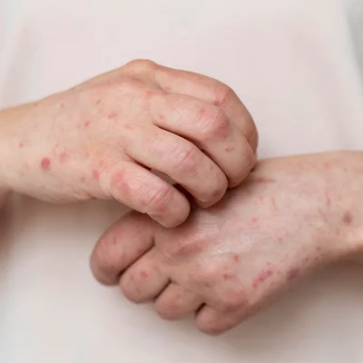Ban Đỏ Lây Nhiễm Khi Mang Thai Có Nguy Hiểm Không?