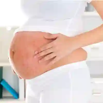 Bệnh Zona Đối Với Phụ Nữ Mang Thai: 3 Phương Pháp Điều Trị